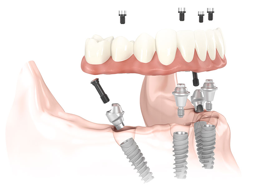 All-on-4 Concord, NH