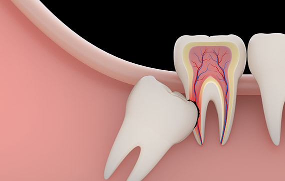 Tooth Extractions Concord, NH