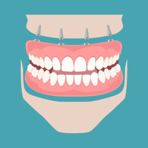 Artist rendering of all on 4 dental implants