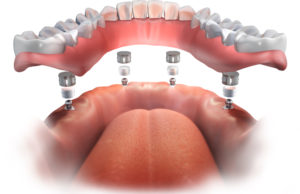 all on 4 dental implants concord nh