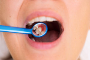 The Hazardous Link Between Diabetes and Gum Disease