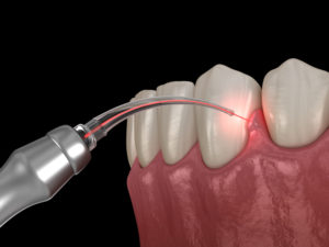 What Is Laser Dentistry and How Does It Work?